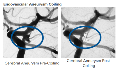 Endovascular Aneurysm Coiling